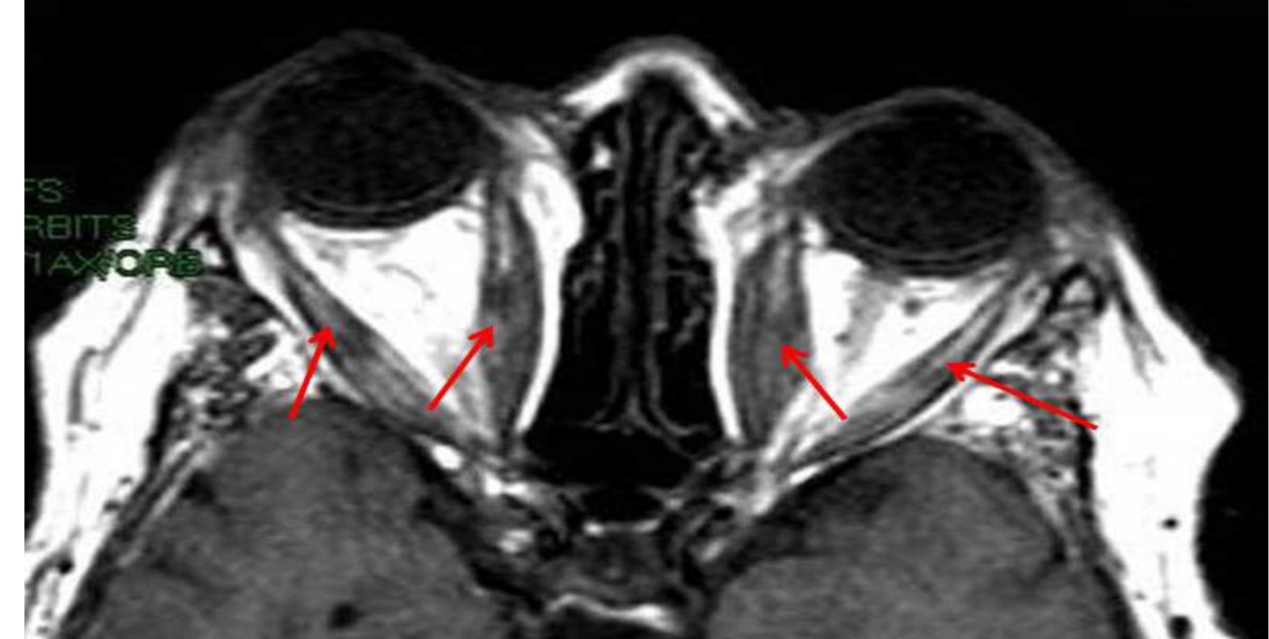 Orbitease Figure 2 - from Stem Cells in Ophthalmology