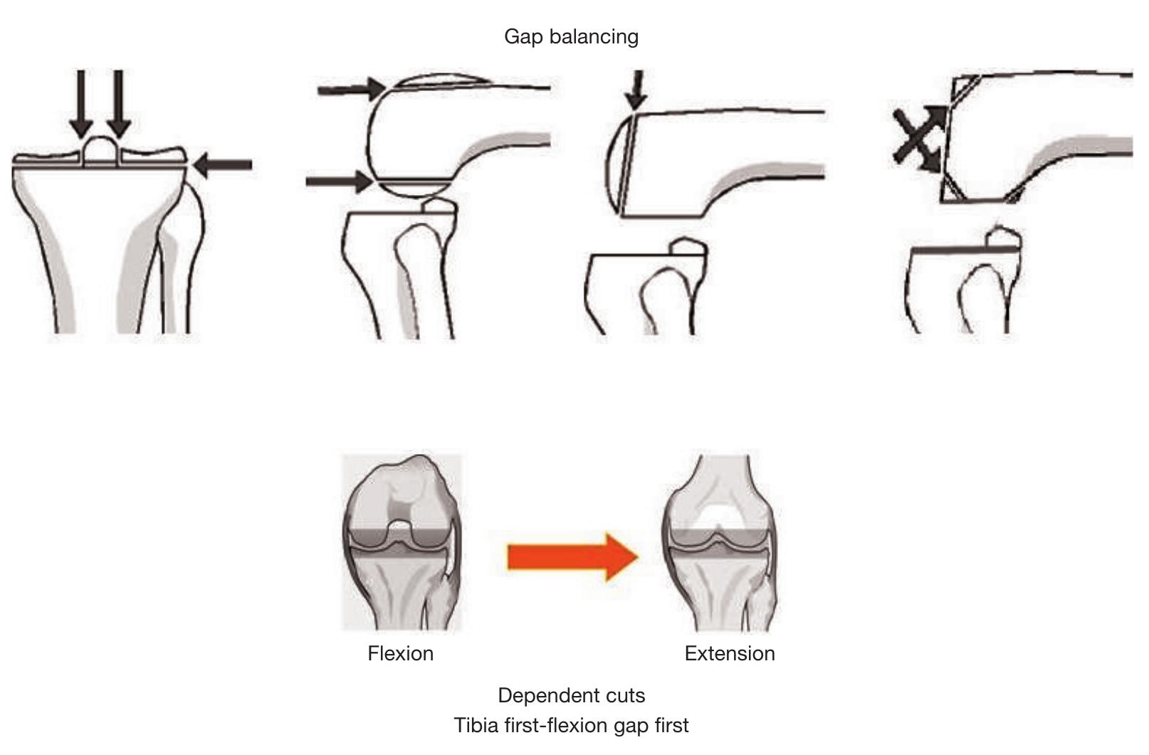 Tka Alignment Rotation Ct (PDF) Rotational alignment of the femoral component in total knee ...