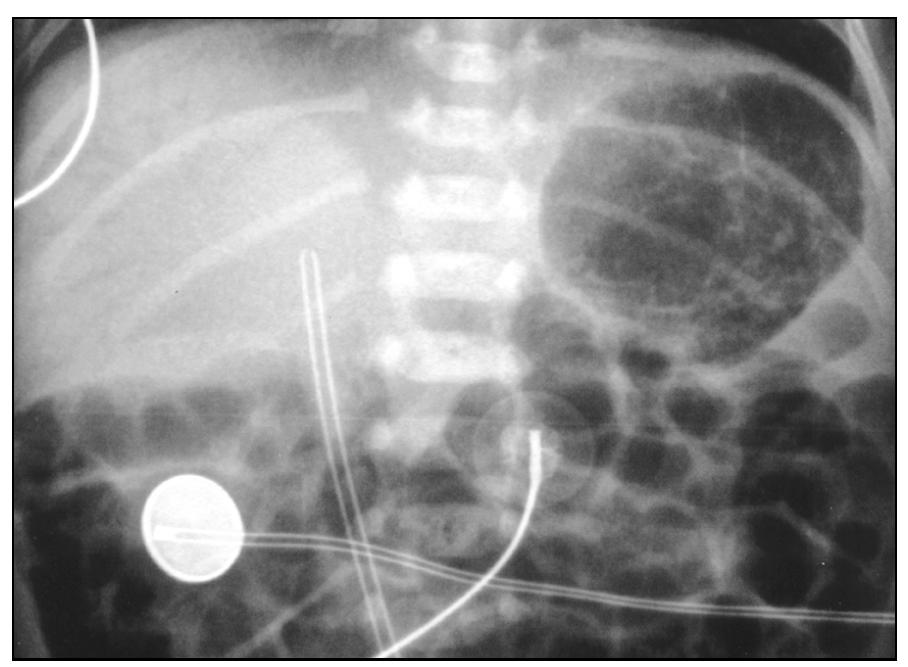 (PDF) Neonates and Umbilical Venous Catheters: Normal Appearance ...