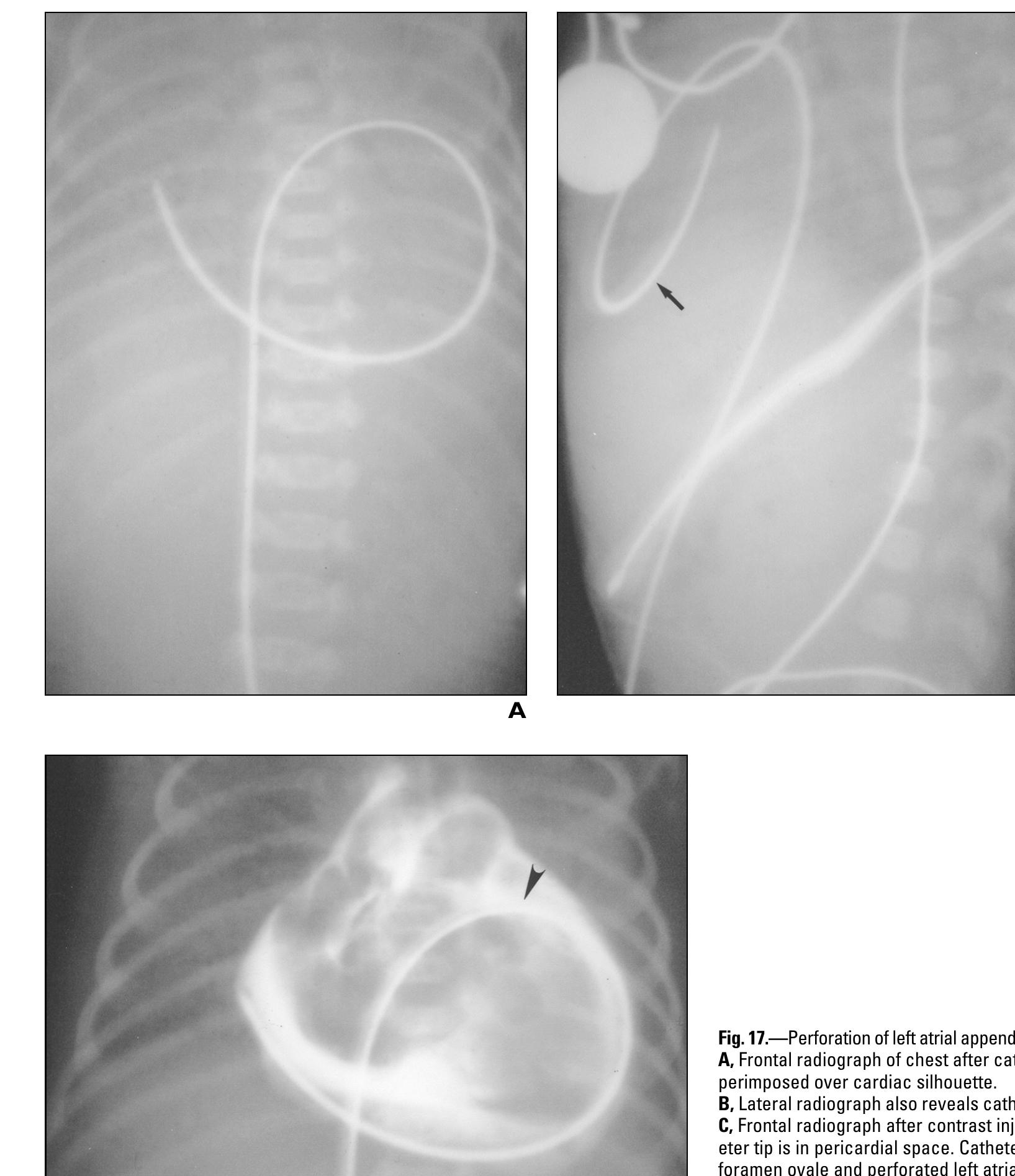 (PDF) Neonates and Umbilical Venous Catheters: Normal Appearance ...