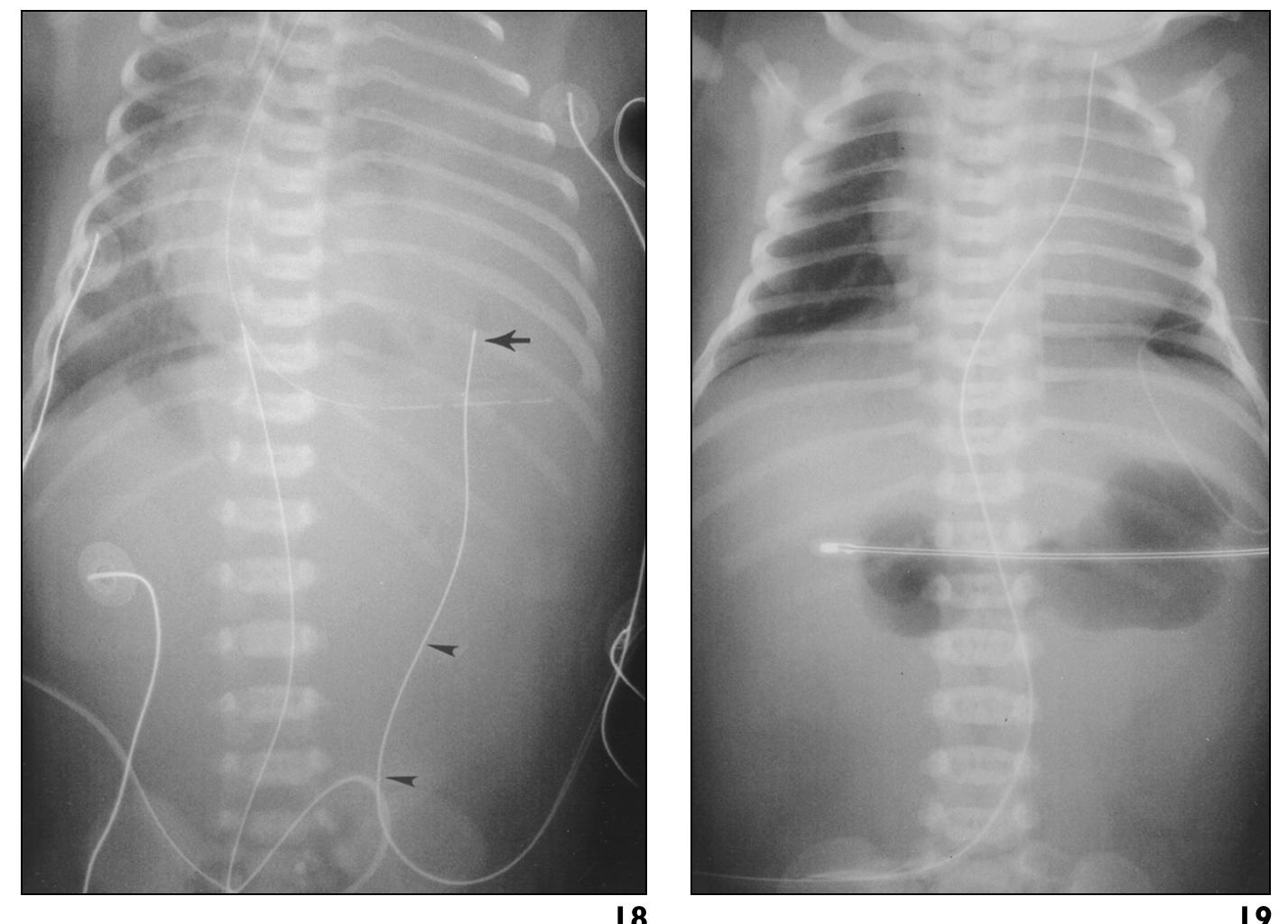(PDF) Neonates and Umbilical Venous Catheters: Normal Appearance ...