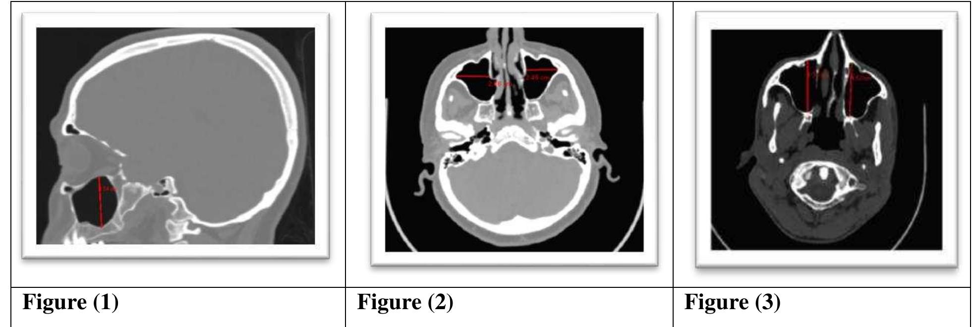 (PDF) Evaluation of Maxillary Sinus Dimensions in Sex and Age ...
