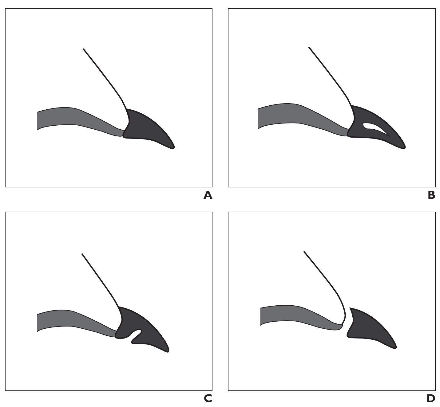 —blankenbaker clock face of labral tears. illustration