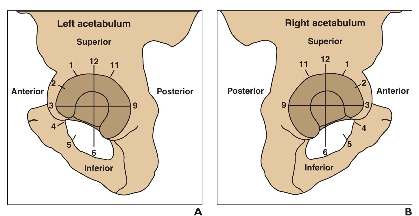 —blankenbaker clock face of labral tears. illustration