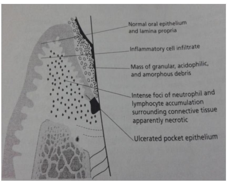 (PDF) Periodontal Abscess-A Localized Collection of Pus a Review