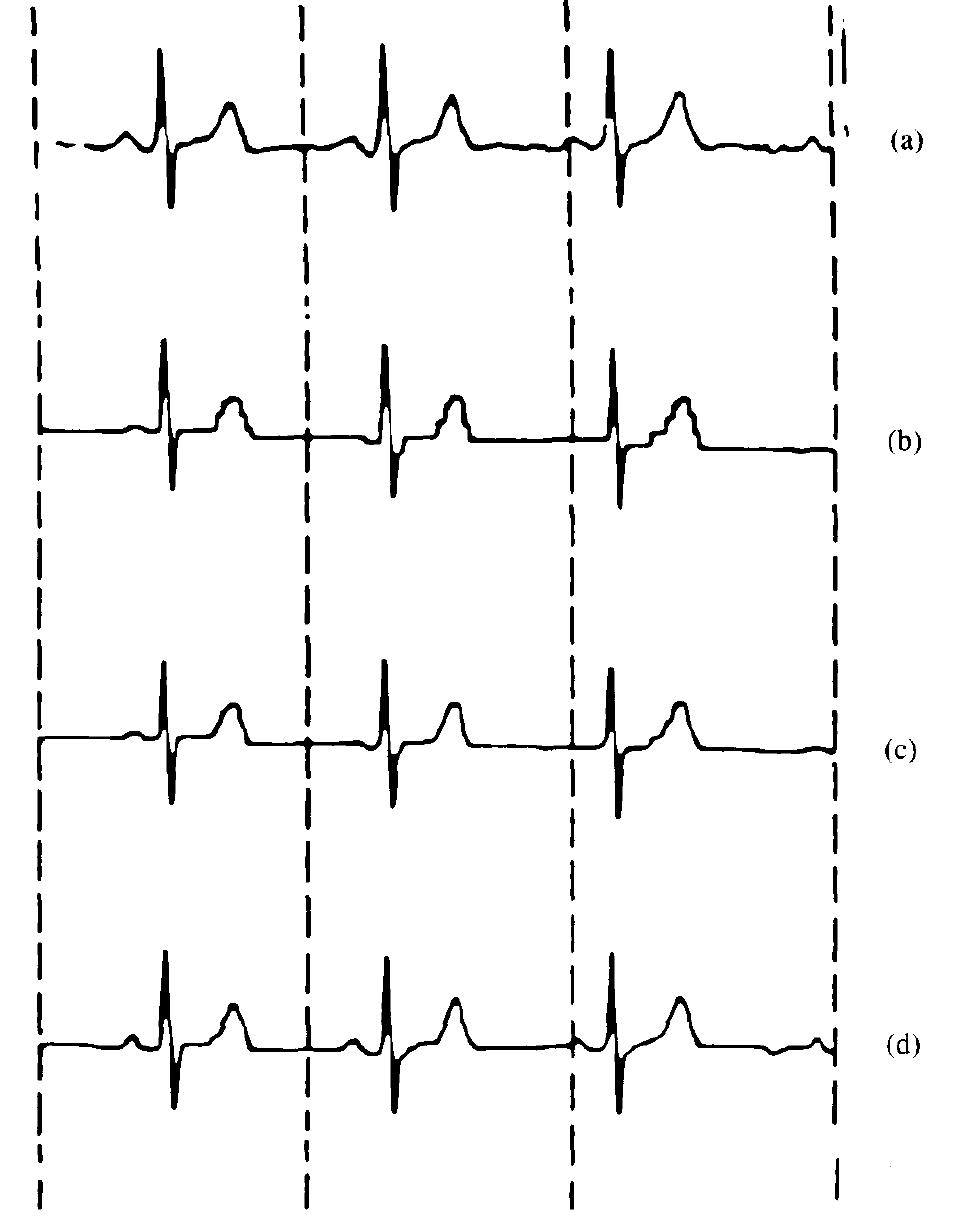 (PDF) ECG data compression techniques-a unified approach