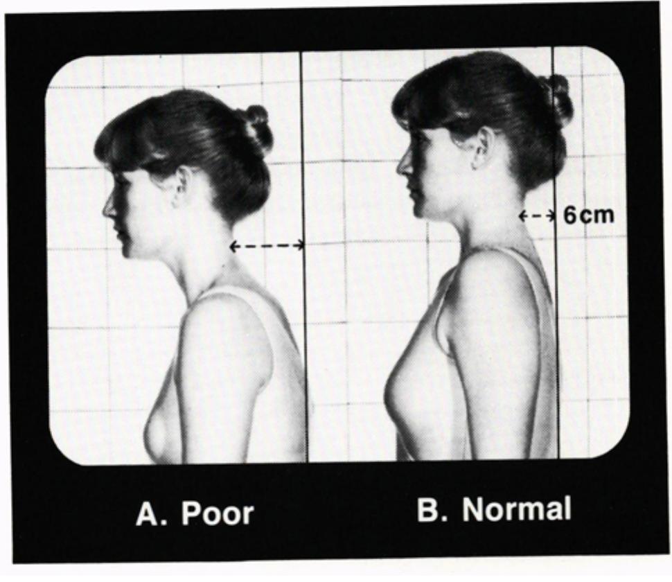 Neck Position Normal Finding (PDF) Biomechanical Relationship of the Cranial, Cervical, and Hyoid ...