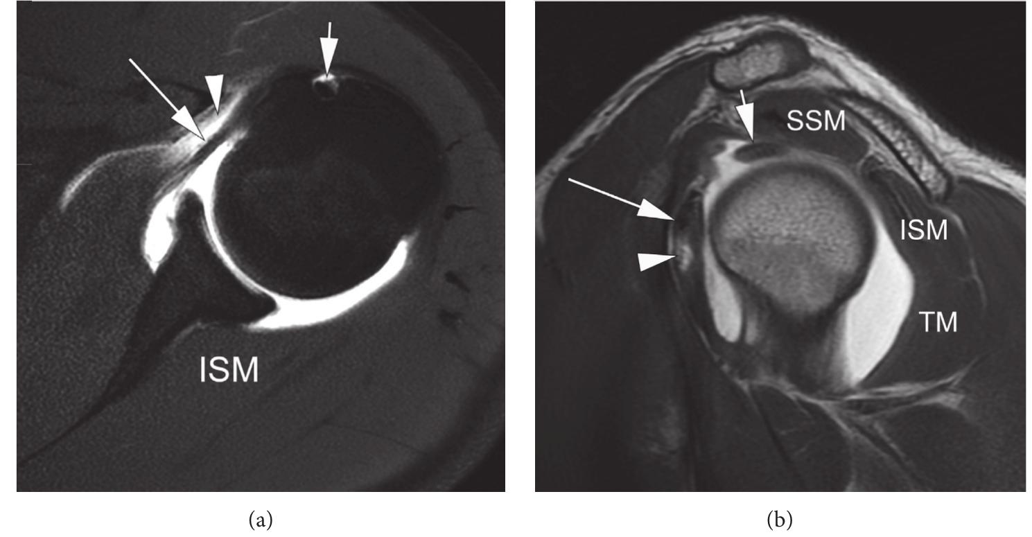 Figure 3 - from Imaging Review of Subscapularis Tendon and