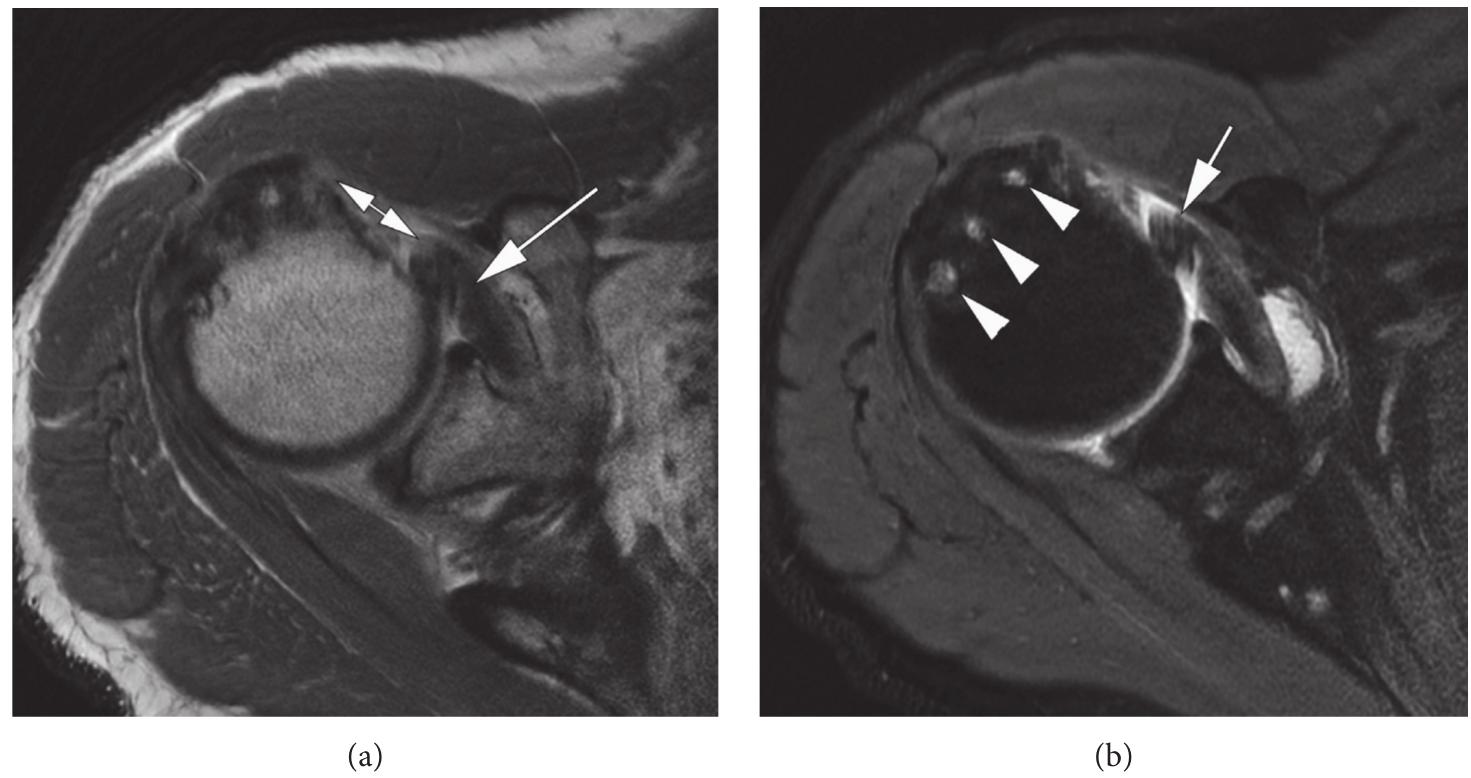 Fall Axially Figure 3 - from Imaging Review of Subscapularis Tendon and
