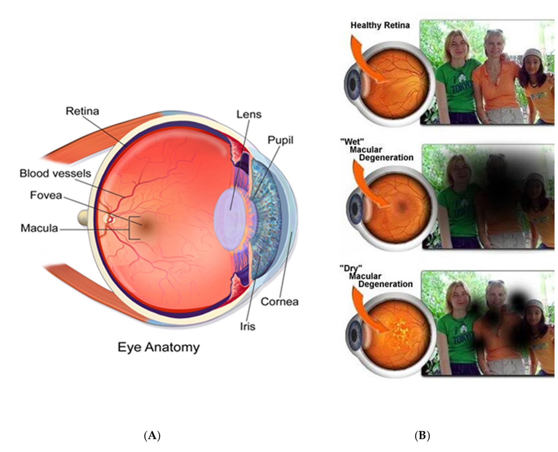 (a) cross-section of eye; (b) vision after macular