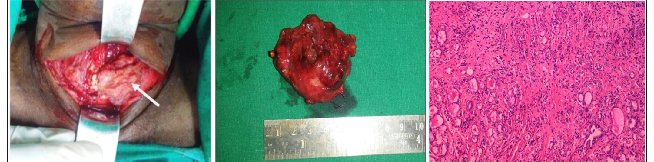 After Ridel (PDF) Riedel's Thyroiditis-A Clinical Enigma