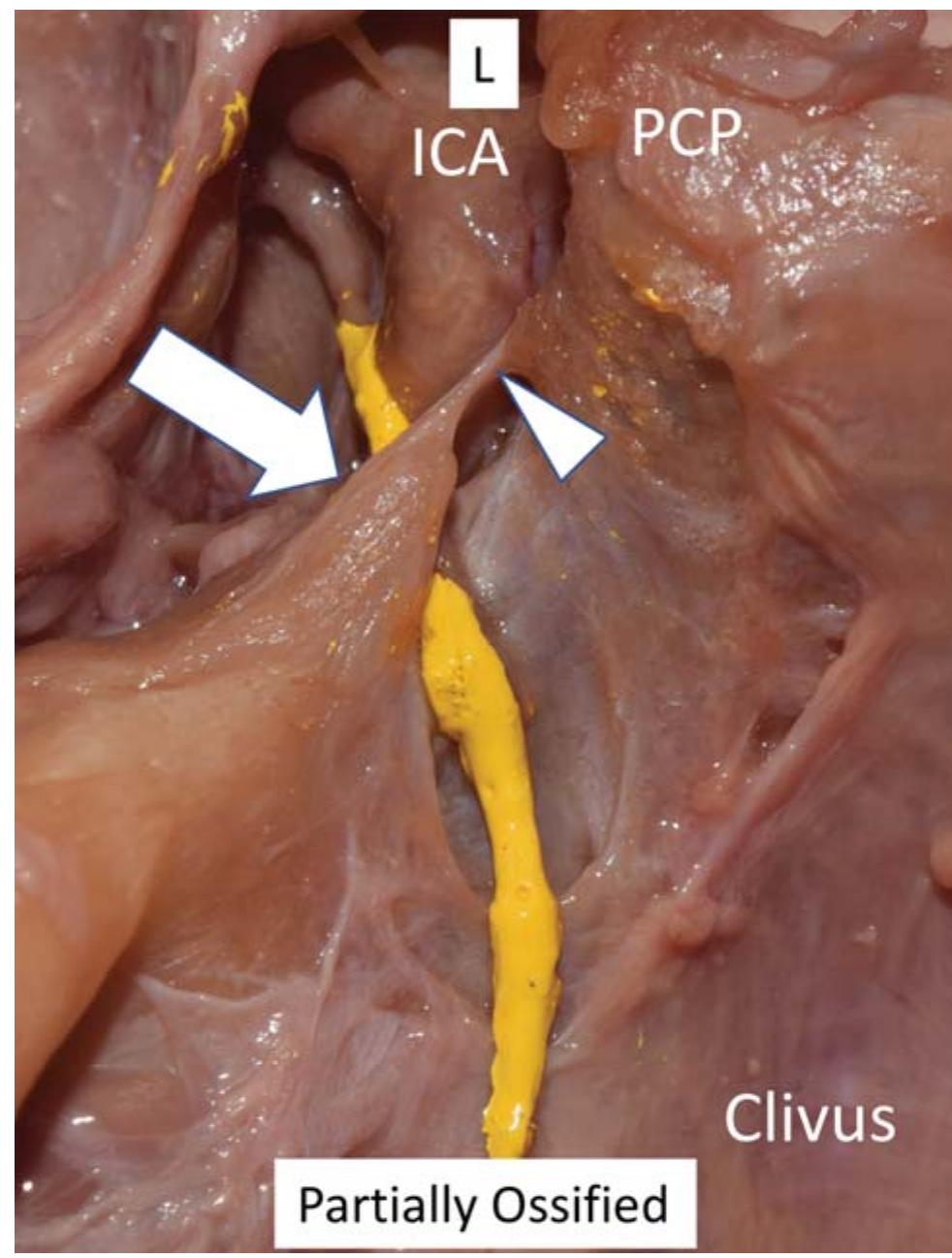 (PDF) The Petroclinoid Ligament: Its Morphometrics, Relationships ...