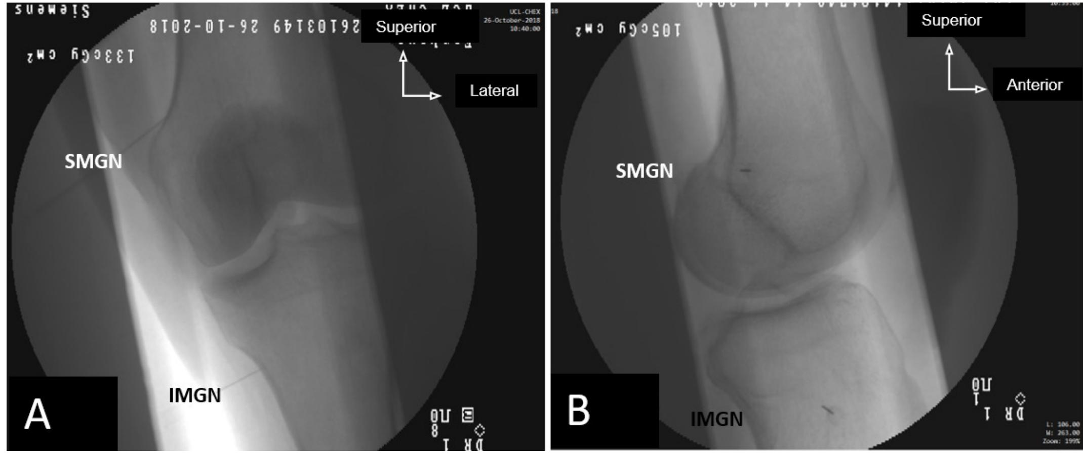 Genicular Injection Mmb (PDF) Accuracy of fluoroscopic-guided genicular nerve blockade: a need ...