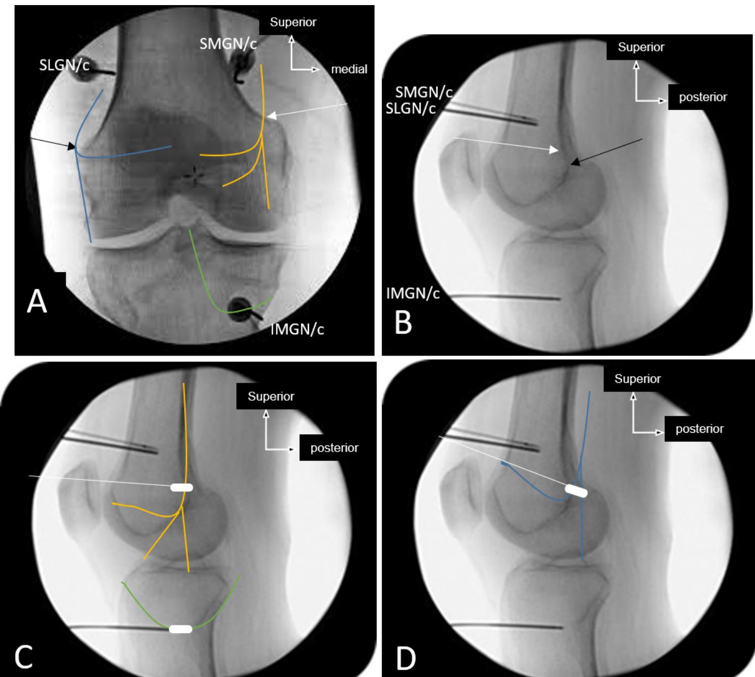 Genicular Rfa Bipolar (PDF) Accuracy of fluoroscopic-guided genicular nerve blockade: a need ...