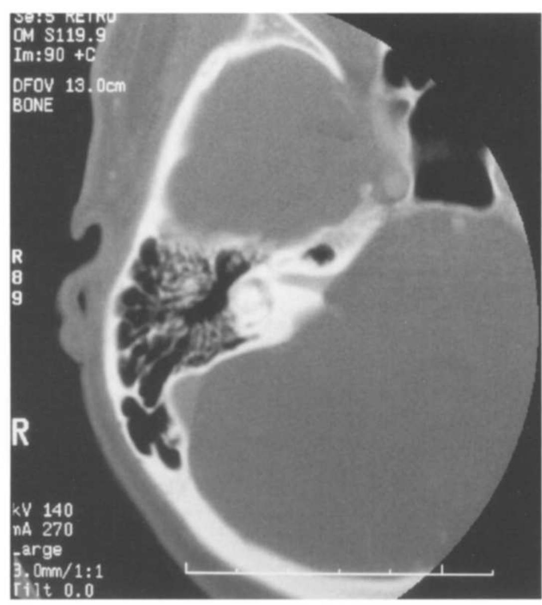 (PDF) Middle cranial fossa approach