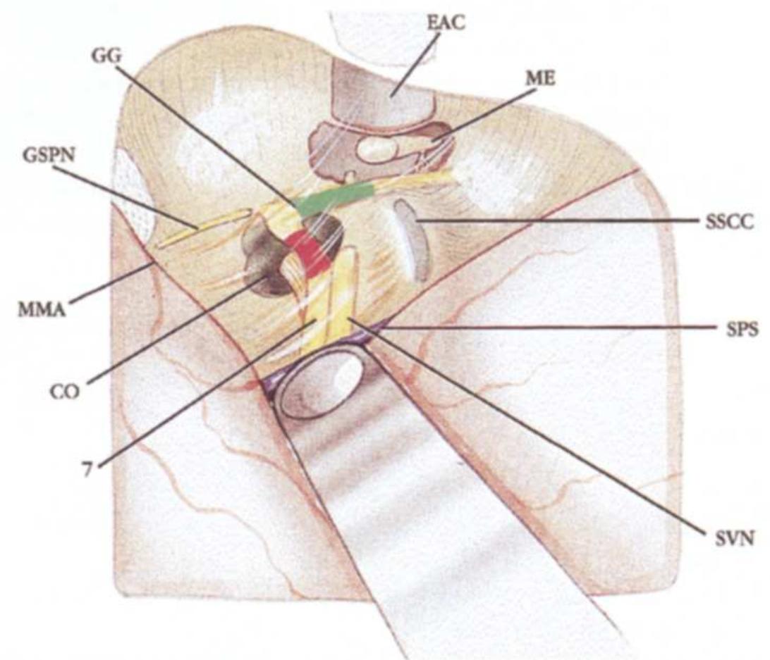 (PDF) Middle cranial fossa approach