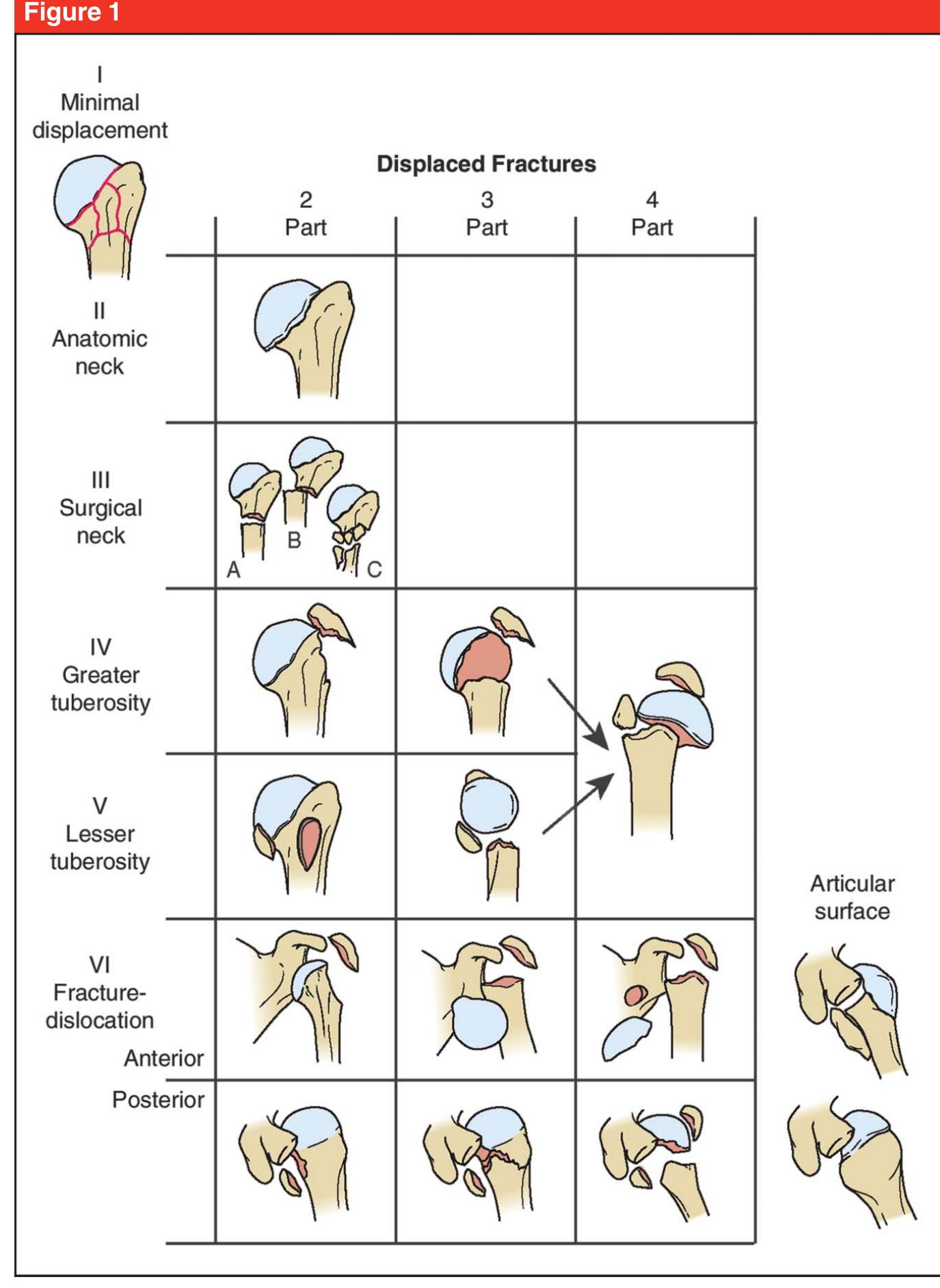 Figure 1 - from Management of Acute Proximal Humeral