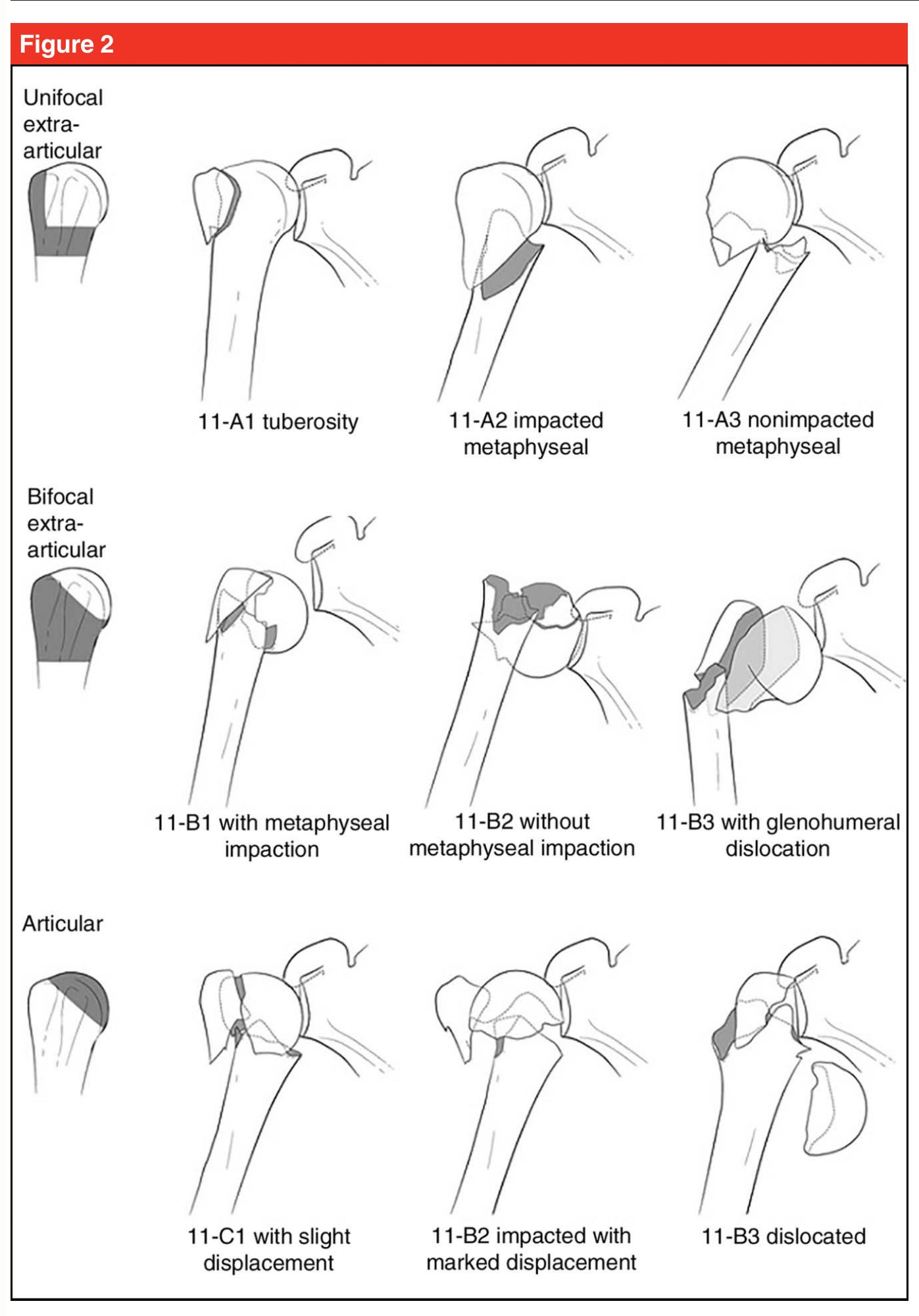 Figure 1 - from Management of Acute Proximal Humeral