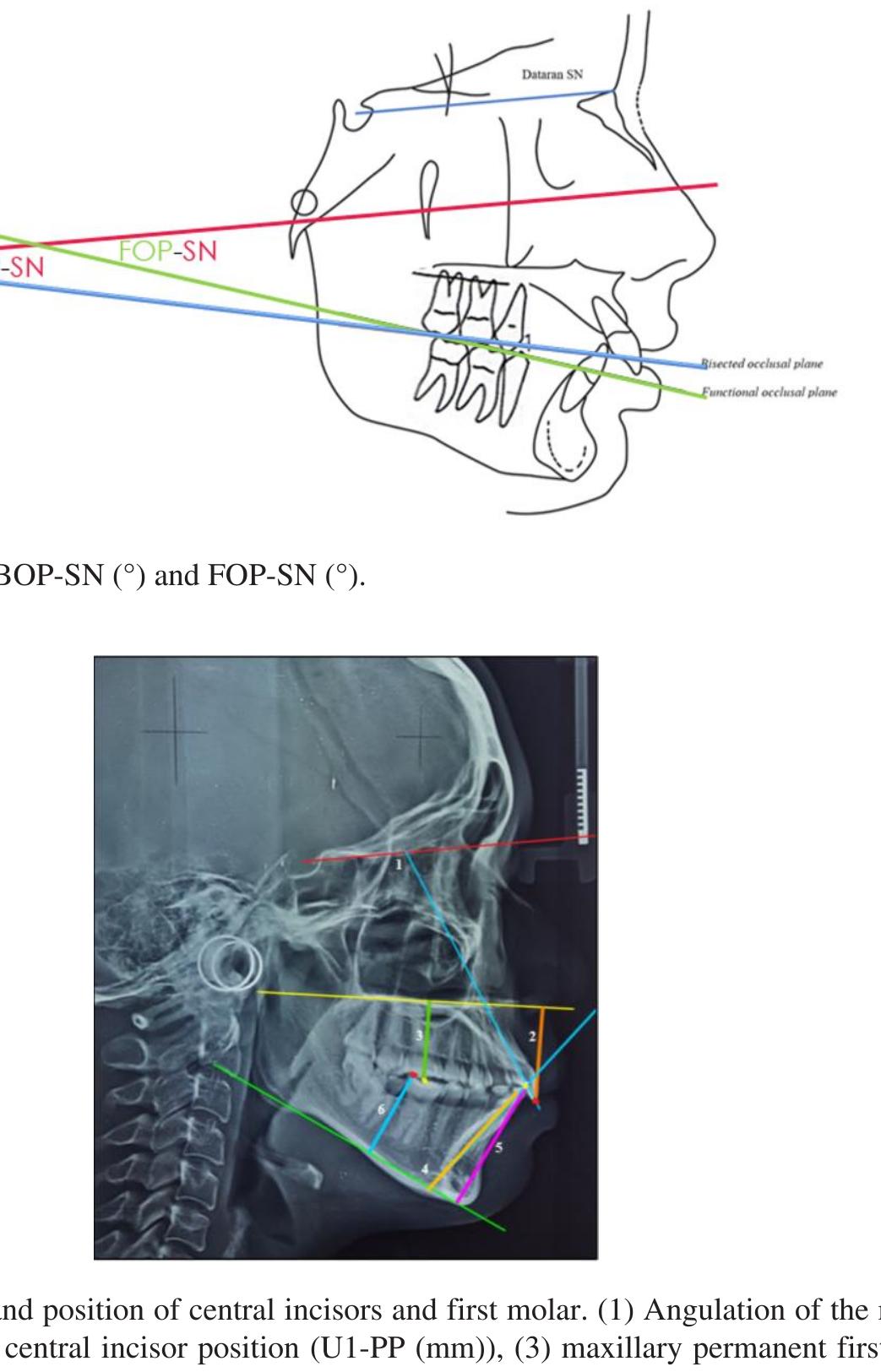 Figure 1 - from The changing of occlusal plane inclination