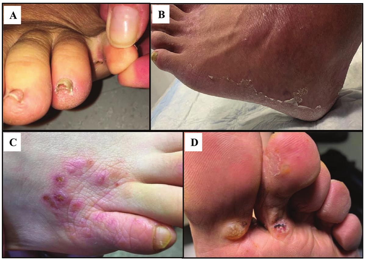 Moccasin Distribution Rash (PDF) Diagnosis and Management of Plantar Dermatoses