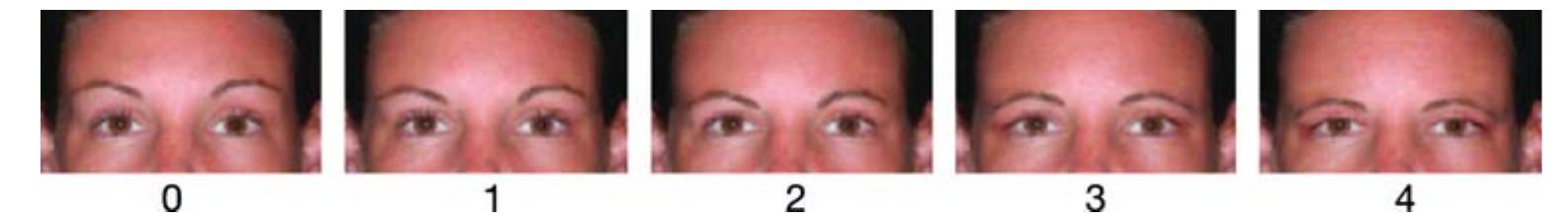 Reference images for the five-point brow positioning grading