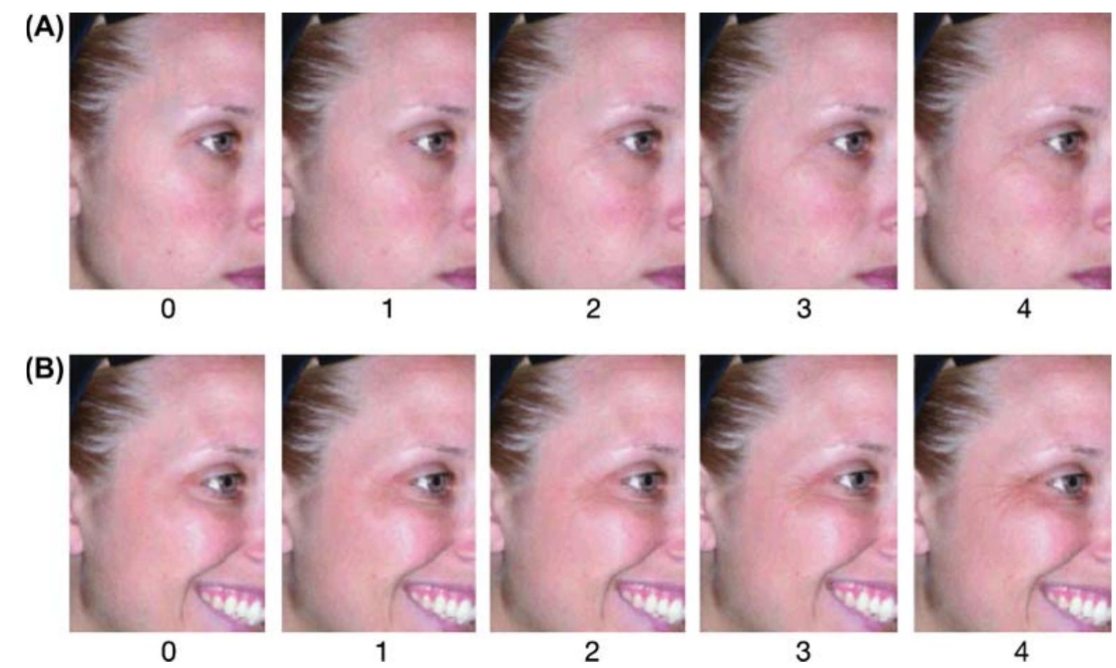 Reference images for the five-point crow’s feet grading