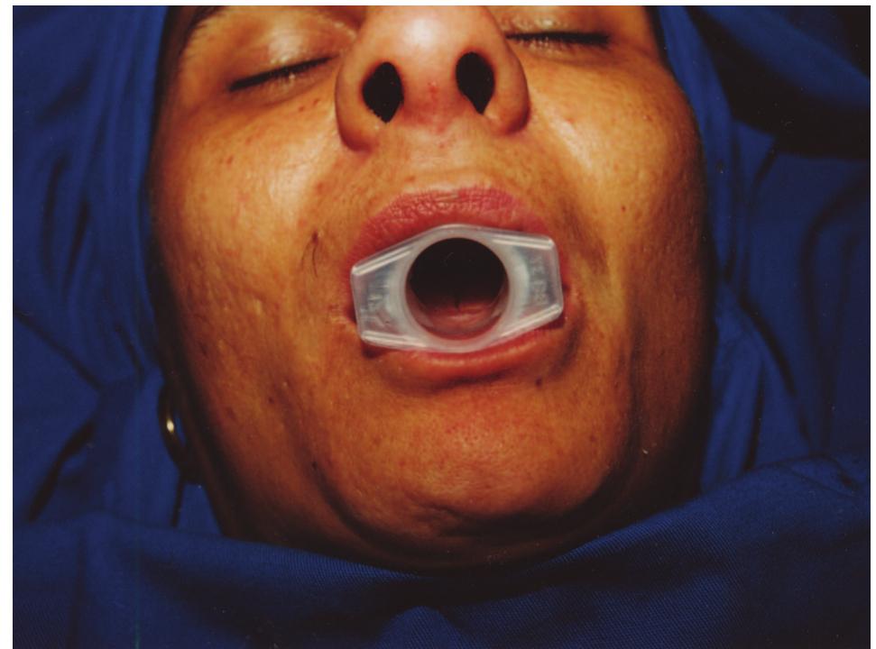 Figure 57 - Angiomyomatous Hamartoma of Inguinal Lymph Nodes