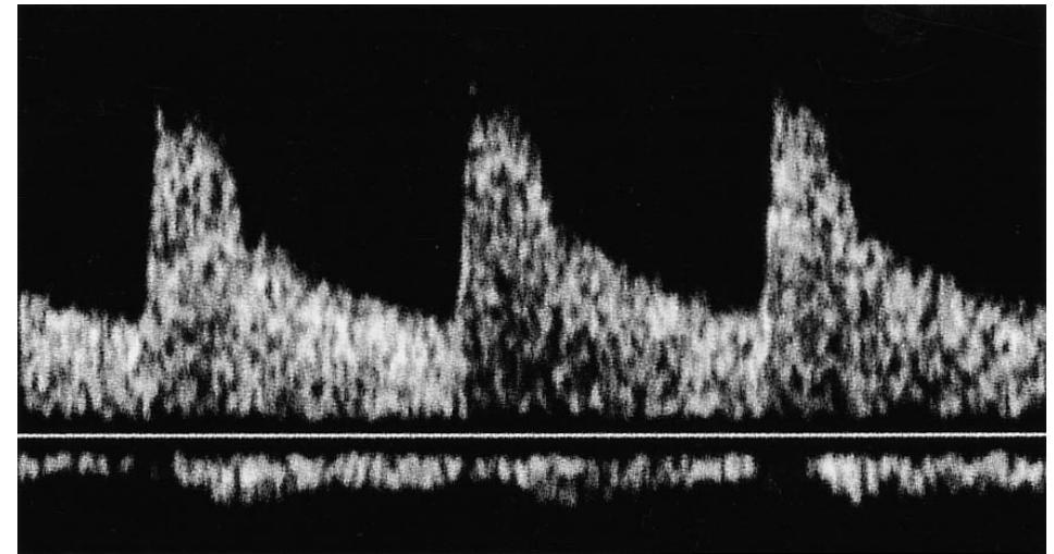 Parvus (PDF) Parvus tardus waveform suggesting renal artery stenosis—remember ...