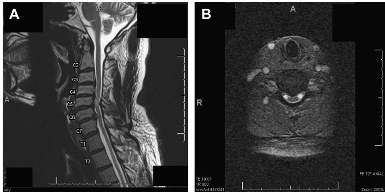 (PDF) Imaging in Radiculopathy