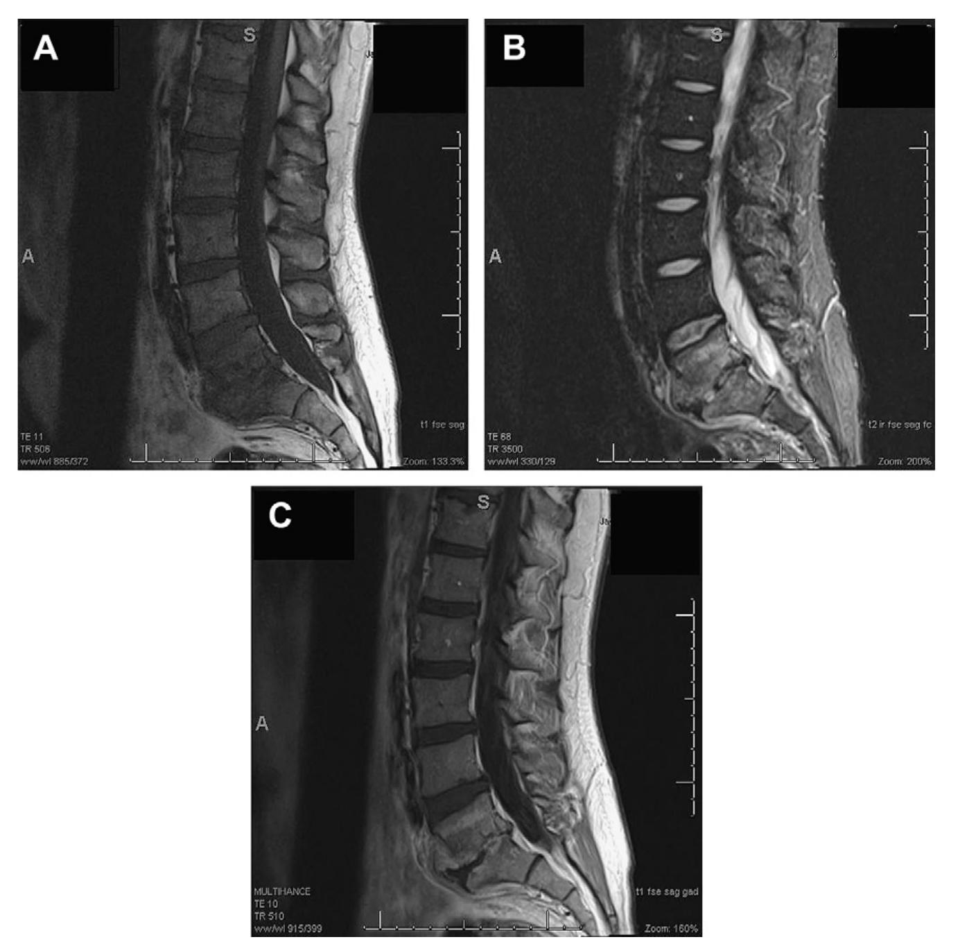 (PDF) Imaging in Radiculopathy