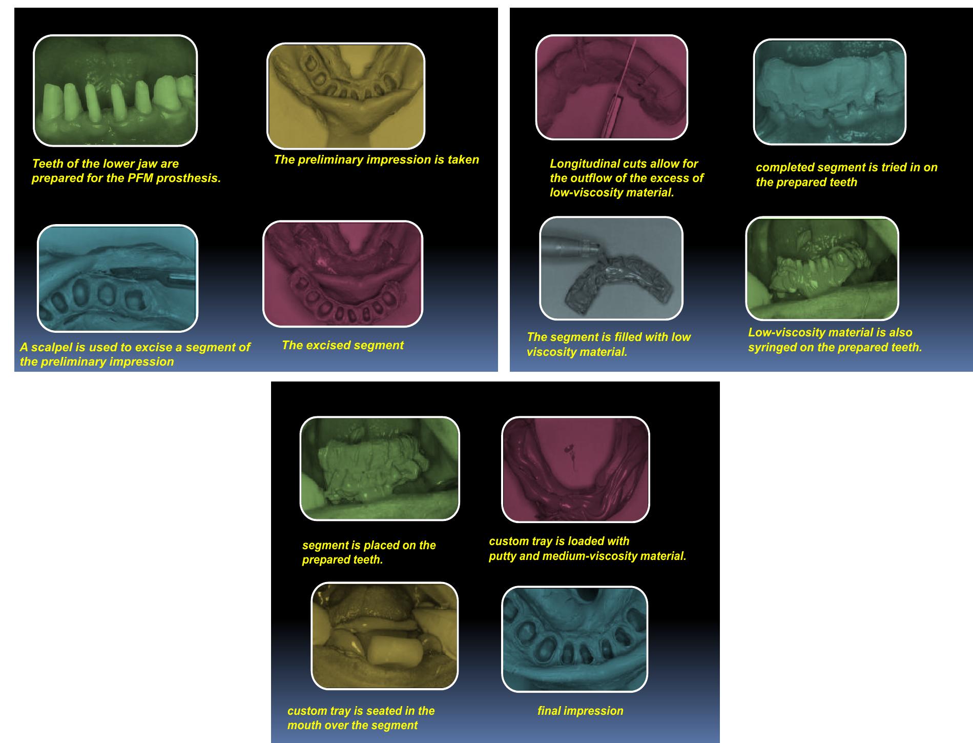 Fixed Impression (PDF) Panorama of Impression Techniques in Fixed Partial Dentures. A ...