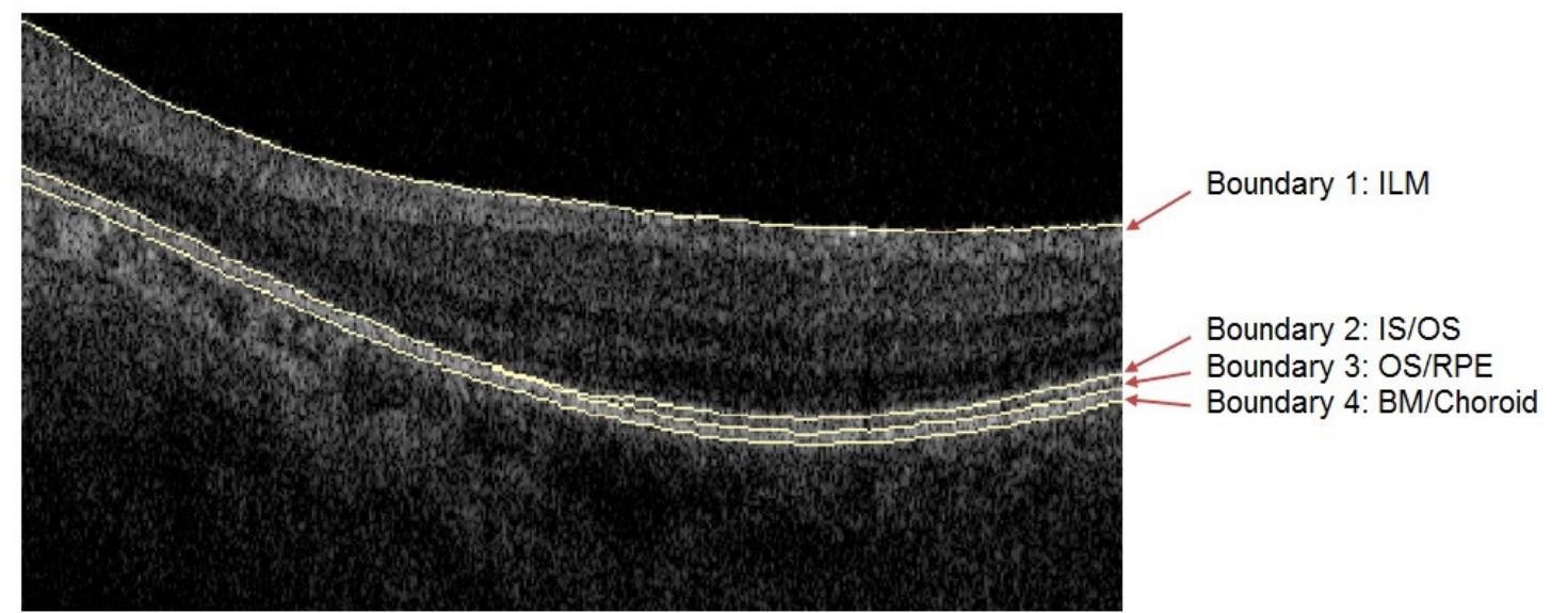 Ilm Rpe Illustration of four retinal boundaries on a scan from a
