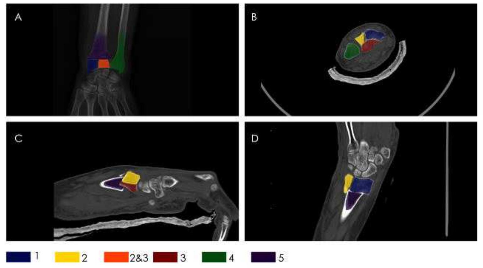 (a) ap view distal radius x-ray, (b) axial view distal