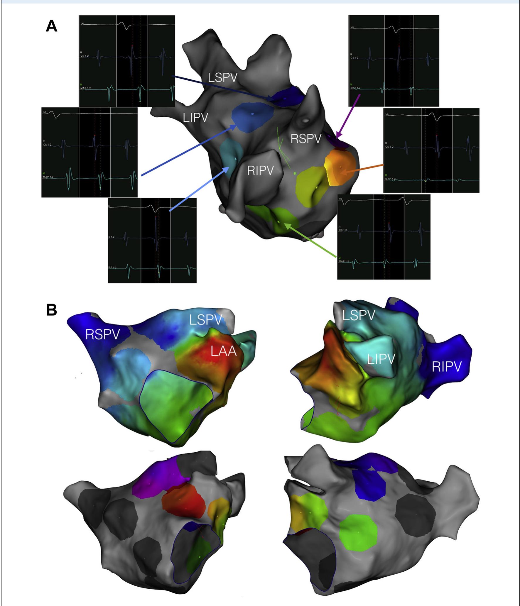 Ppis Activity Map (a) rhythmia. (b) carto. the high-density map (top) and the