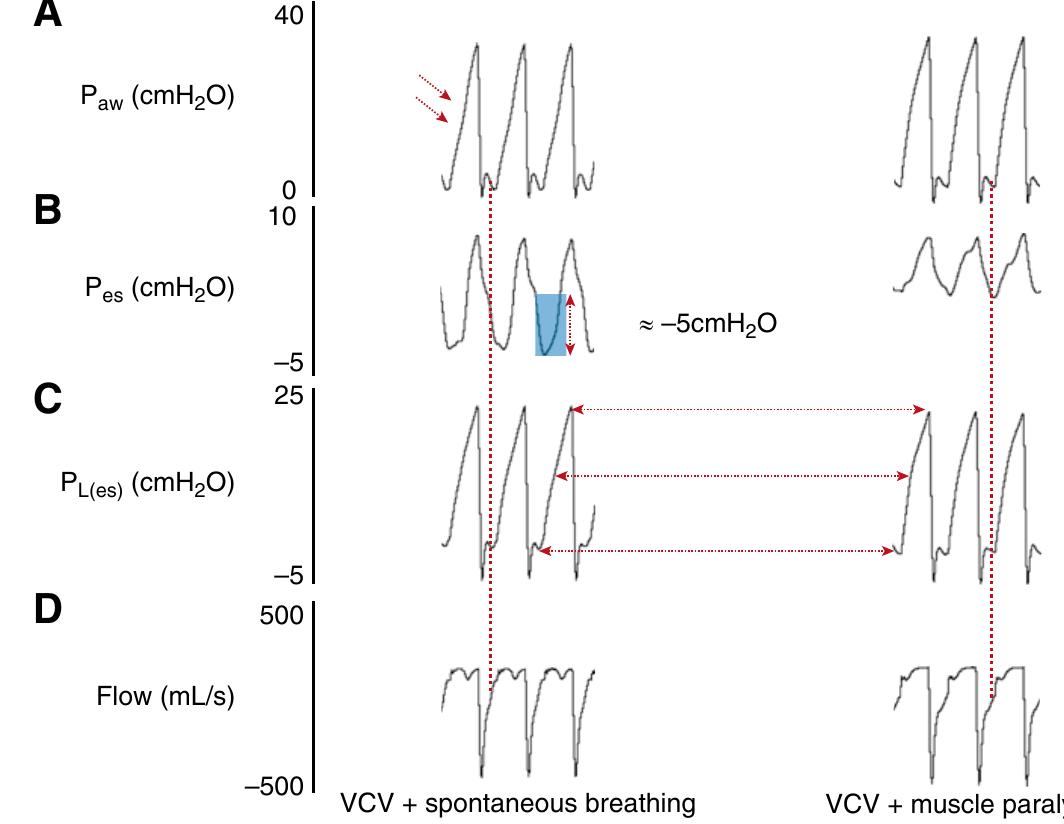 Illustrative esophageal and local pleural pressure in normal