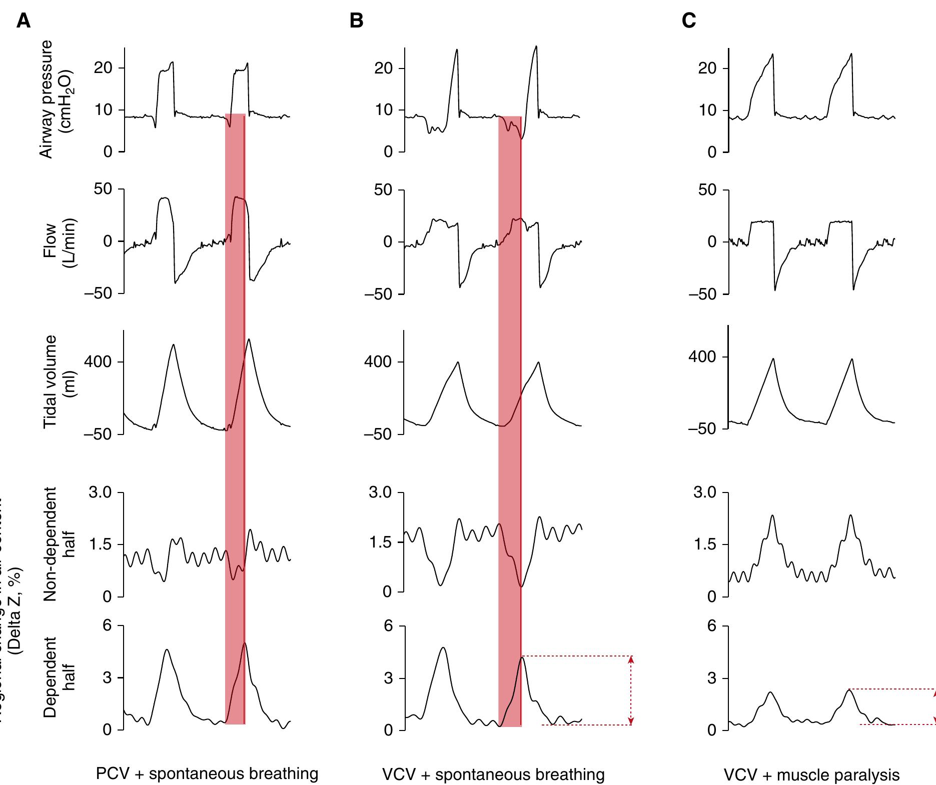 Illustrative esophageal and local pleural pressure in normal