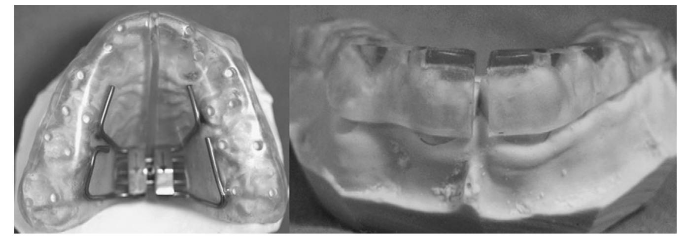 (PDF) Maxillary expansion in the mixed dentition: rapid or semi-rapid?