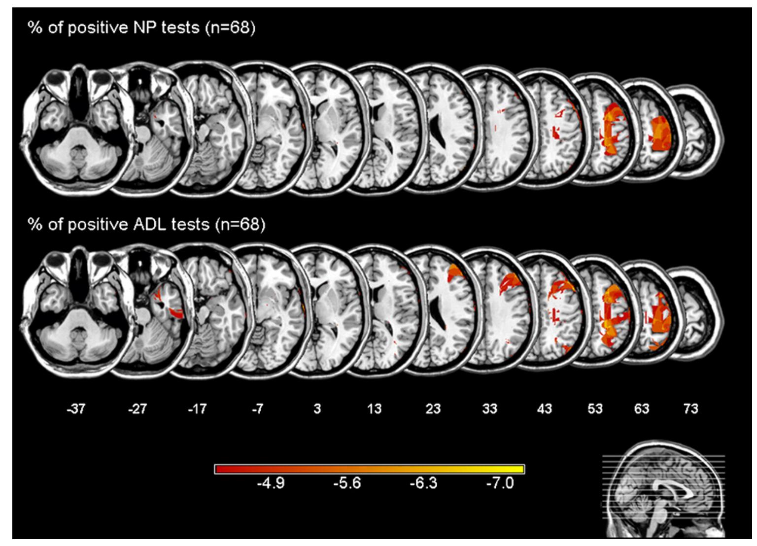 (PDF) Testing for neglect in right-hemispheric stroke patients using a ...