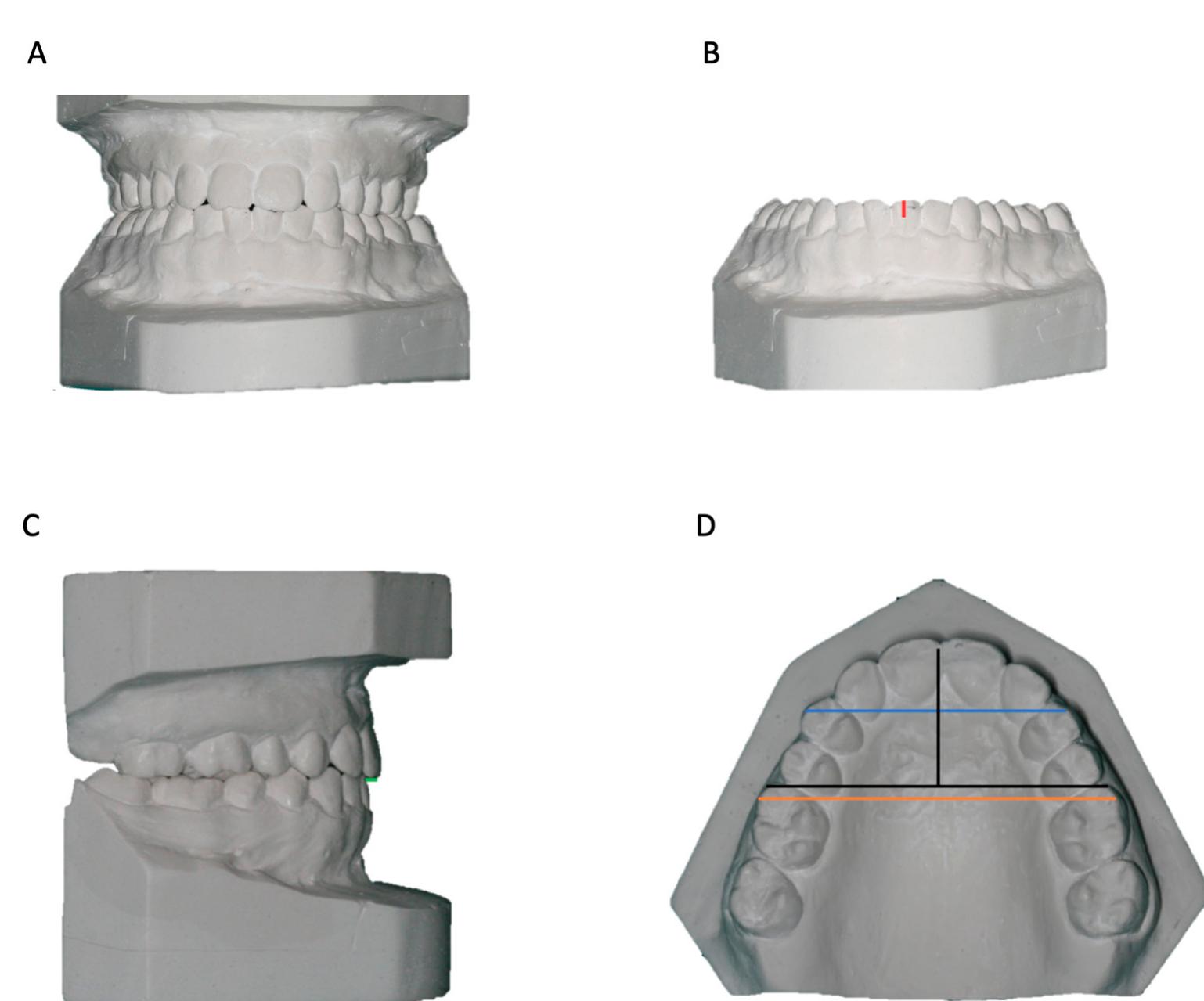 (PDF) Relapse after Orthodontic-Surgical Treatment: A Retrospective ...