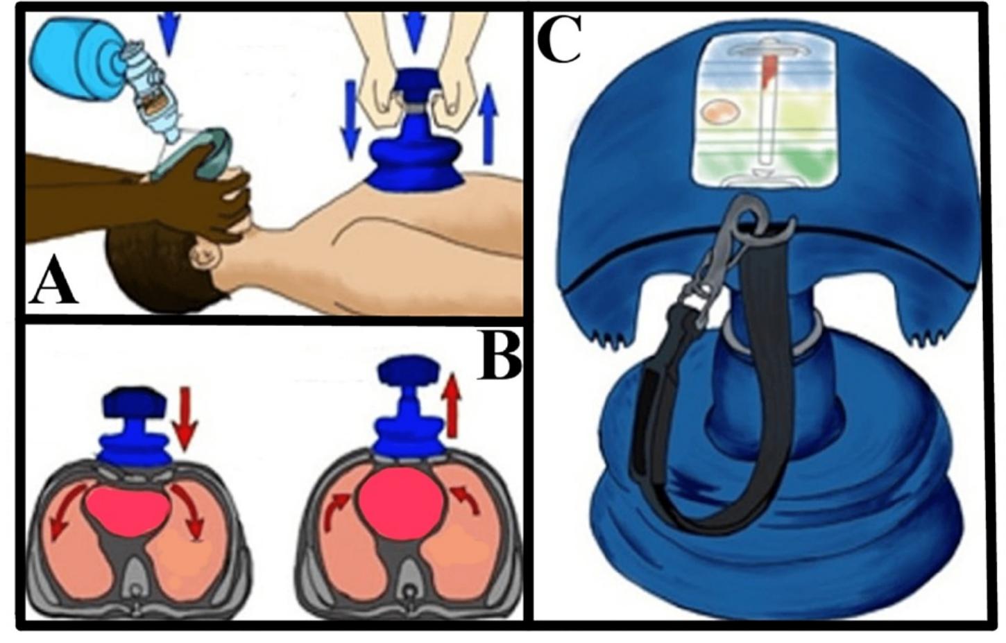 (PDF) A Review of CPR Augmentation Devices