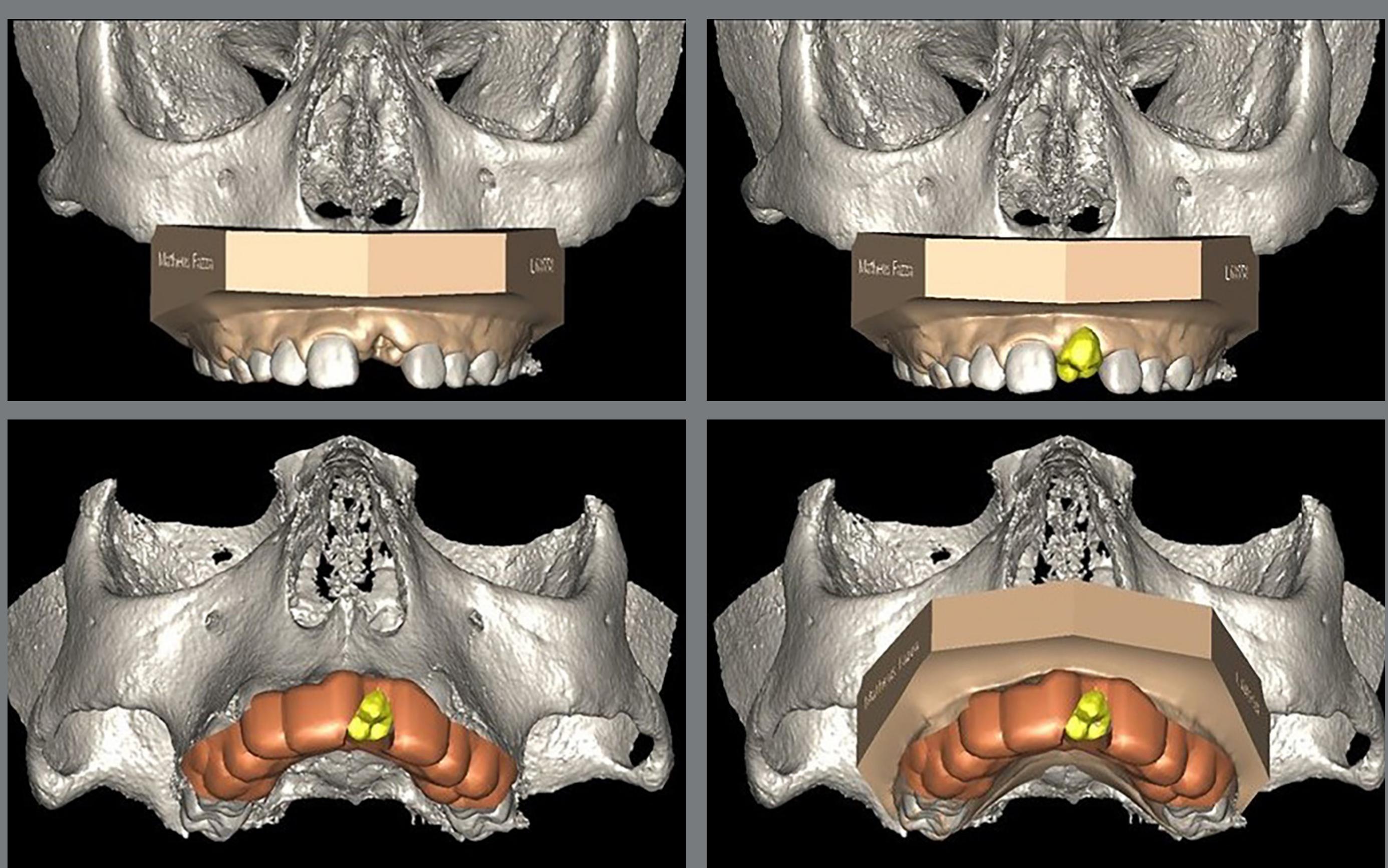 Superimposition of maxillary cbct, intraoral scan and