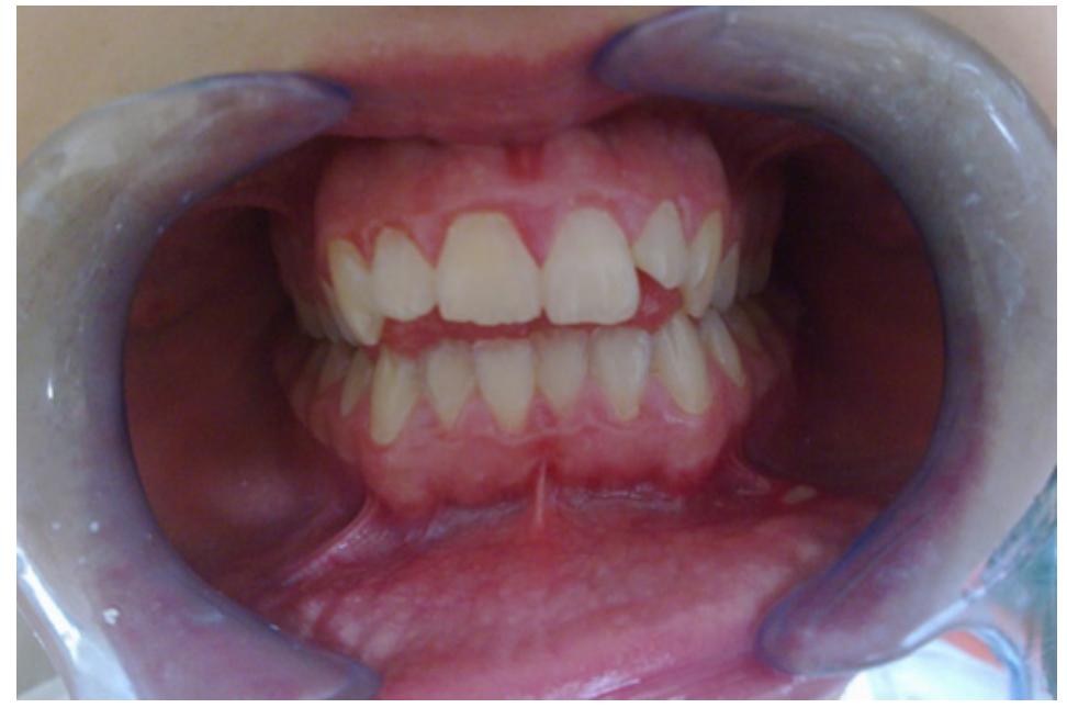 (PDF) Orthodontics treatment open byte with fixed Damon technique