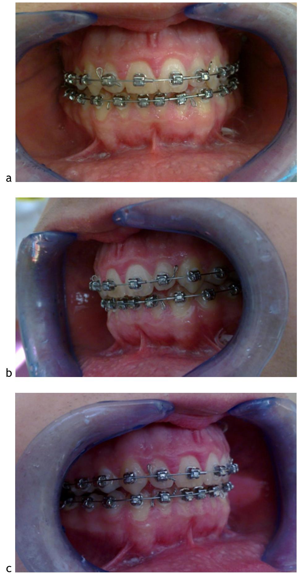 (PDF) Orthodontics treatment open byte with fixed Damon technique