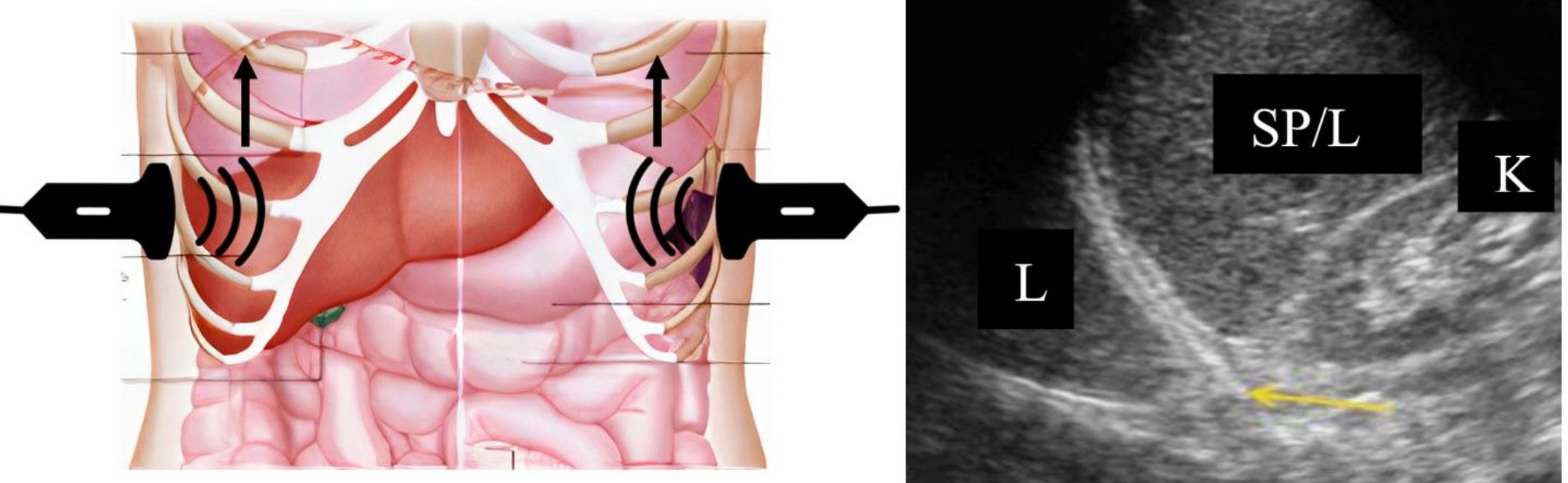 Liver Sensor Schematic location of the transducer and marker for right