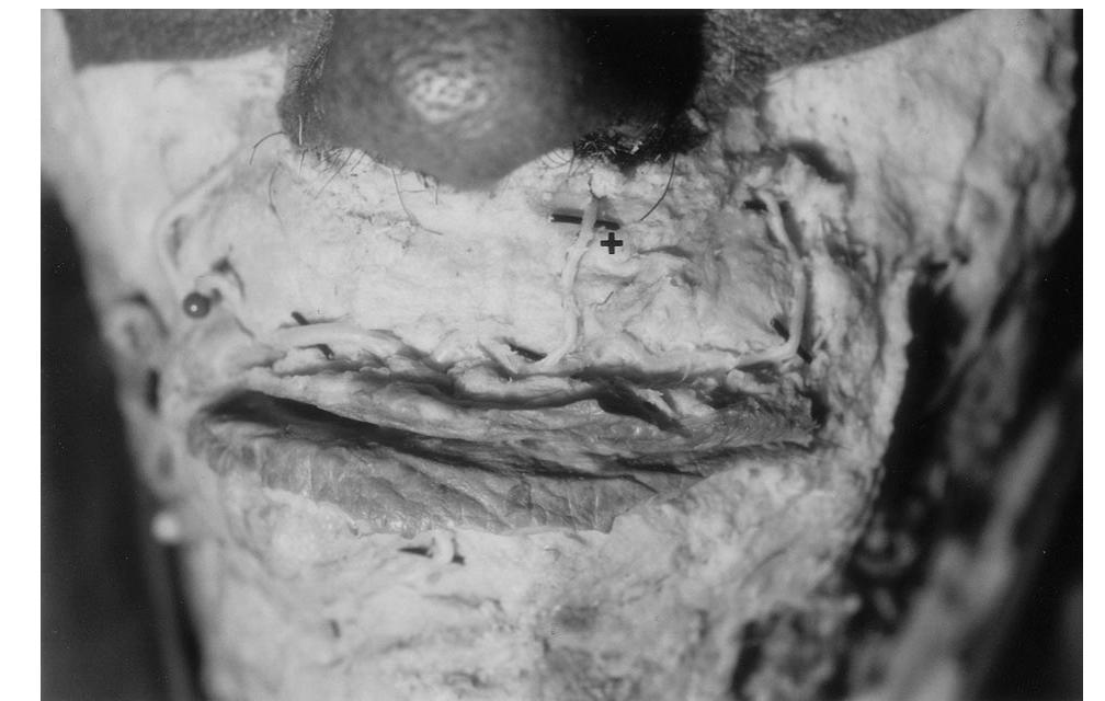 Figure 1 - from Cadaveric Study of the Arterial Anatomy of