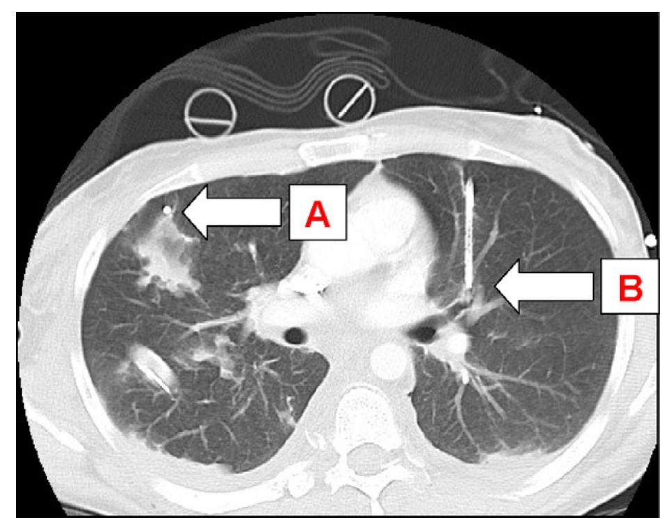 (PDF) Pleural decompression and drainage during trauma reception and ...