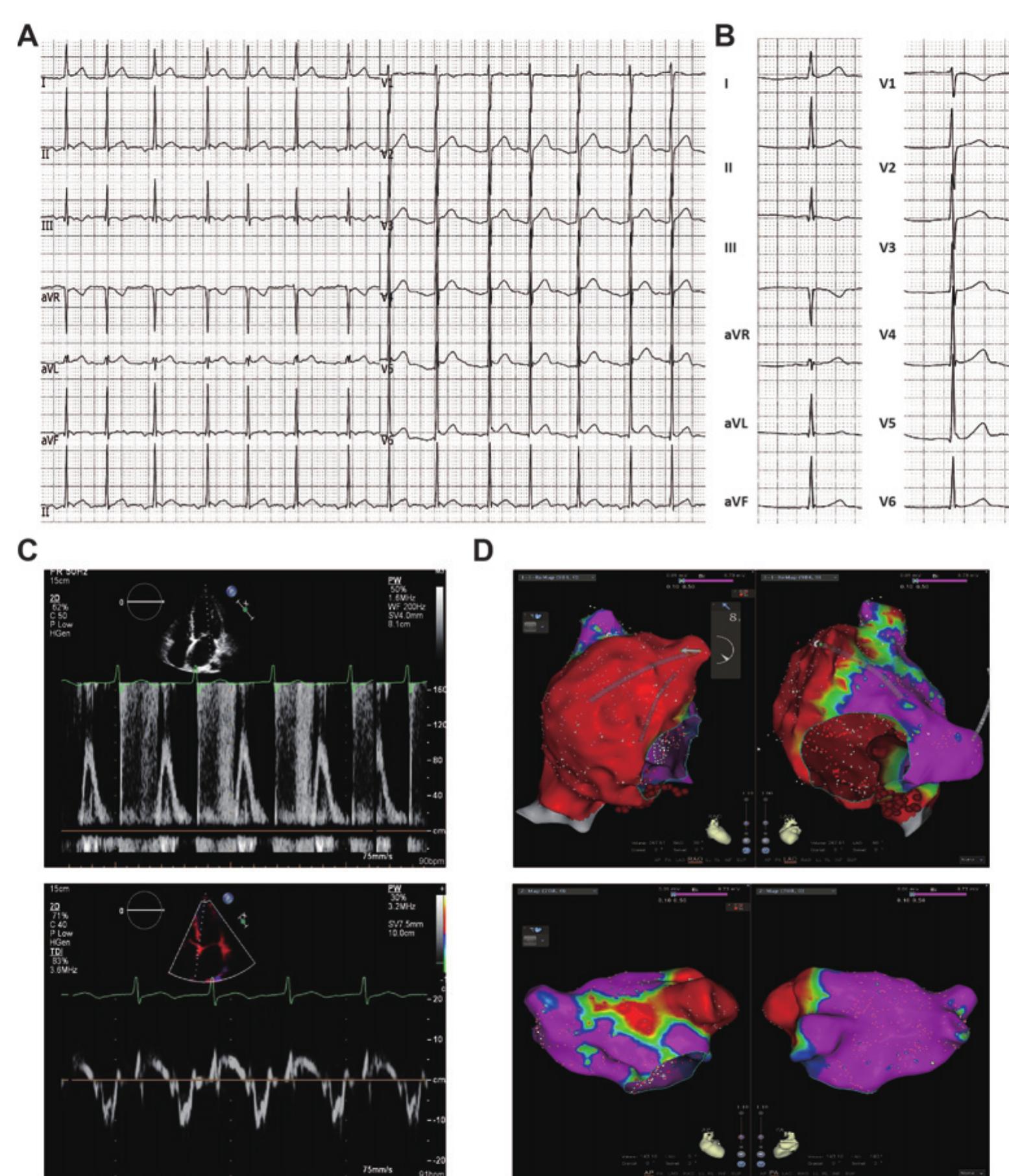 Tricular (PDF) Embolic stroke of unknown source (ESUS) in young patients