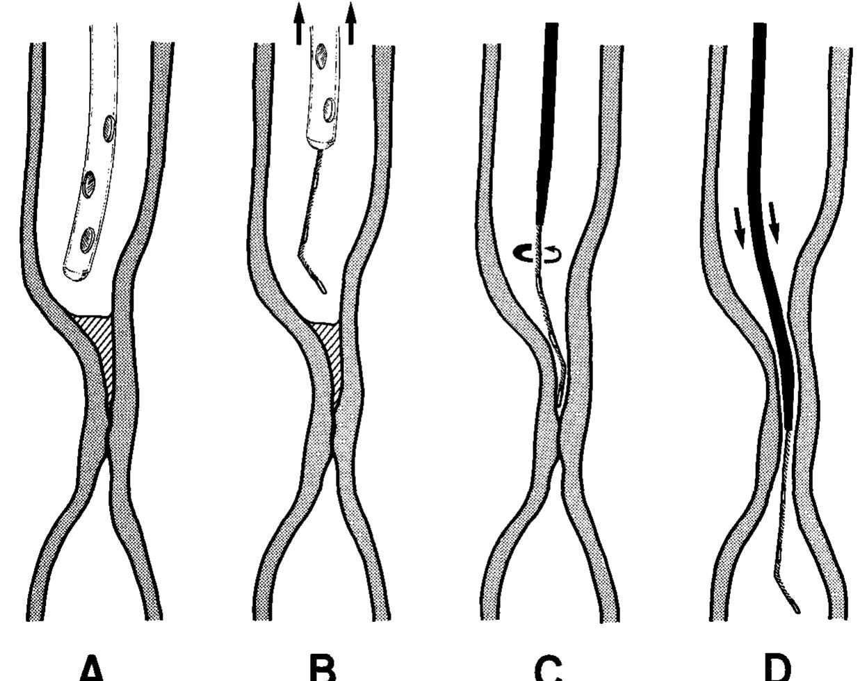 Intestinal Intubation (PDF) Applications and techniques of gastrointestinal intubation