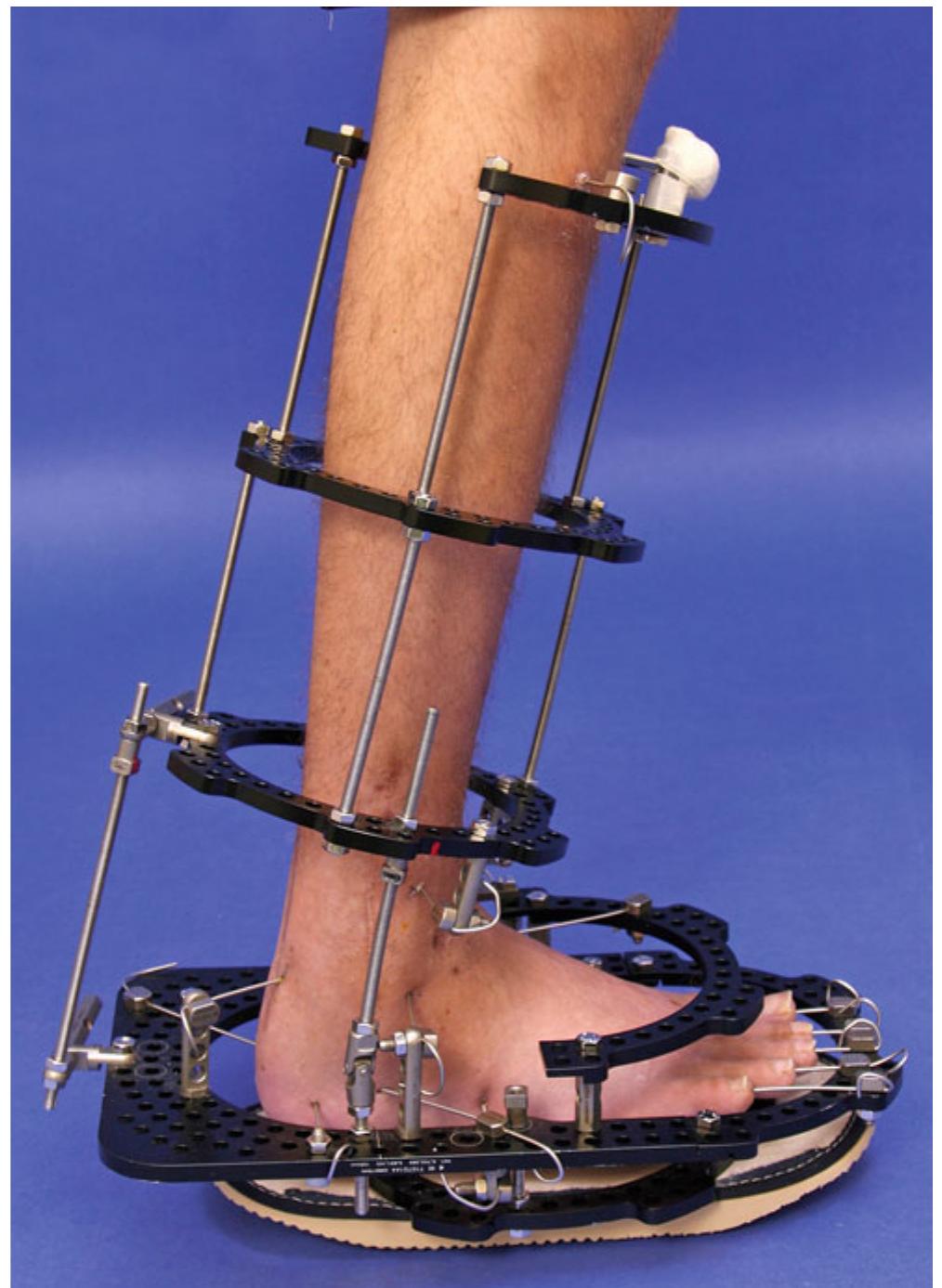 (PDF) Case 76: Equinus Contracture Correction with External Fixation