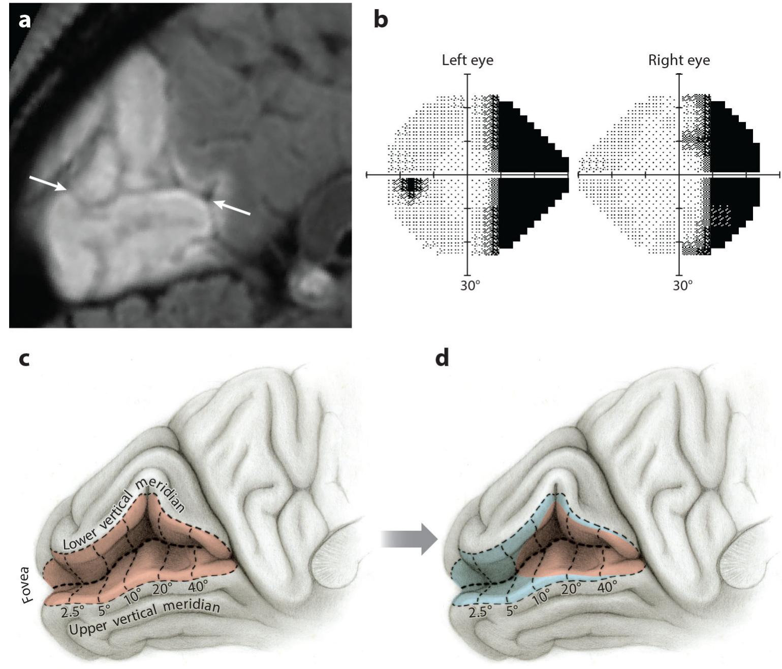 (PDF) The Mechanism of Macular Sparing